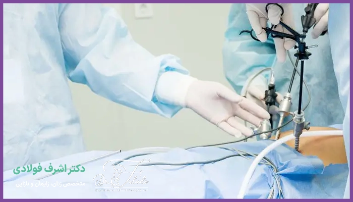 بهترین جراح لاپاراسکوپی فیبروم رحم