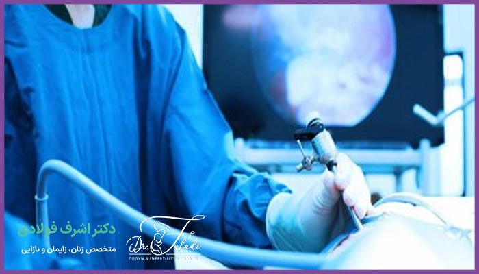 لاپاراسکوپی فیبروم برای چه کسانی مناسب است؟